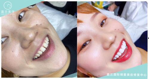 齿雕美牙视频,揭秘牙齿美容的神奇之旅